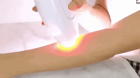 Depilación Laser